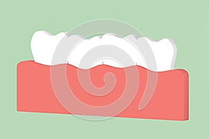 Crowding teeth malocclusion