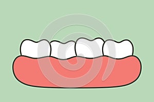 Crowding teeth malocclusion, dental problem
