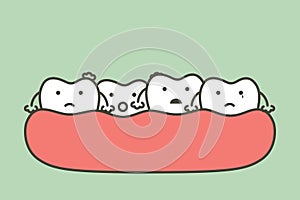 Crowding teeth malocclusion, dental problem