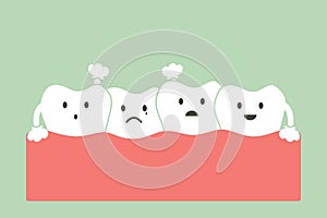 Crowding teeth malocclusion