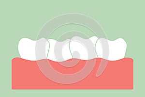 Crowding teeth malocclusion