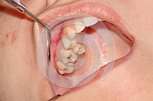 Crowding of the teeth of the upper jaw and caries of the upper m