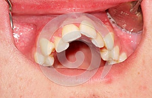 Crowding of the teeth of the upper jaw