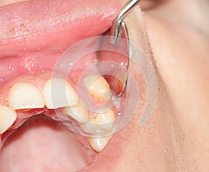 Crowding of the teeth of the upper jaw