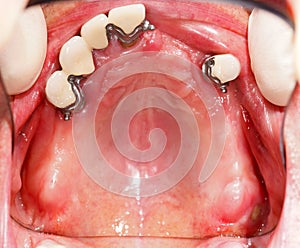 Crowns For Prosthesis In Mouth