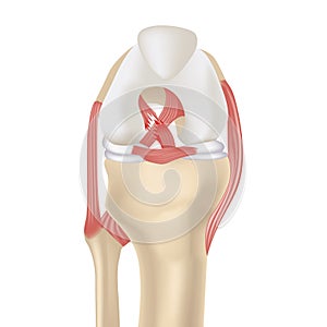 Cruciate ligament rupture. Realistic rendering of the knee joint, drawer syndrome.