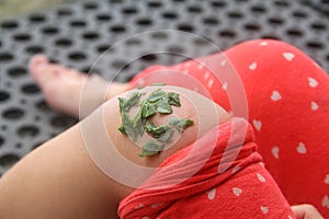 crushed binahong leaves attached to the leg of an injured child.  Binahong leaves are fast in wound healing.