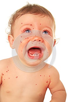 Crying baby boy with measles