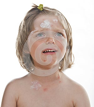 Crying little girl with smallpox photo