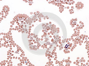 Cryoglobulinemia. Peripheral blood smear. photo