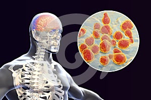 Cryptococcal meningitis, medical concept