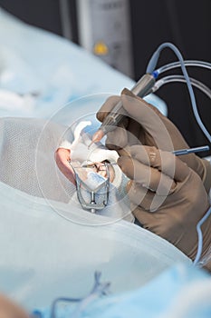 Crystalline lens replaceable surgical method