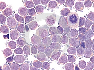 CSF involvement in acute lymphoblastic leukemia.