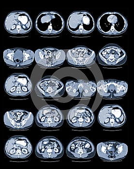 CT Abdomen