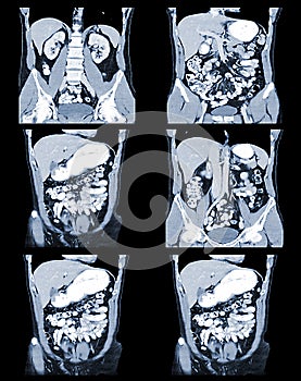 CT Abdomen