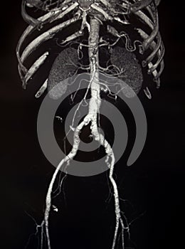 CT of Abdominal and Pelvic vessels