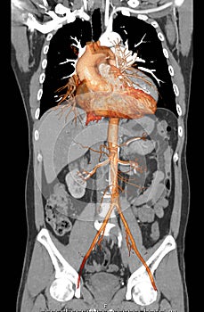 CT angiography of ABDOMINAL AORTA