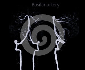 CT angiography of the brain or CTA brain showing basilar artery