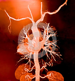 CT Angiography (Computed tomography angiography: CTA) of abdominal aorta