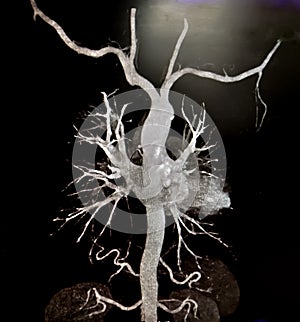 CT Angiography (Computed tomography angiography).
