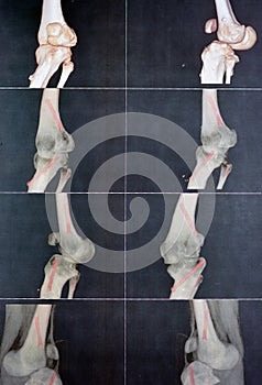 CT angiography of the left knee 3D view showing patent popliteal artery and its bifurcations tibial and peroneal arteries on a photo