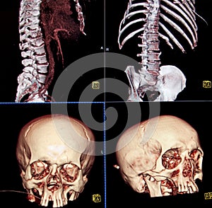 CT of body and head bones