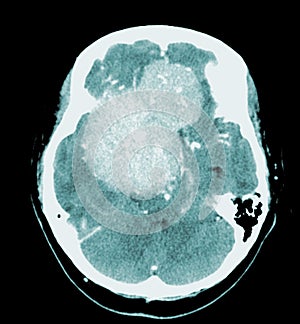 CT Brain Axial scans hyperdense mass with homogeneous, and mild perilesional brain edema at the right front-temporal-parietal