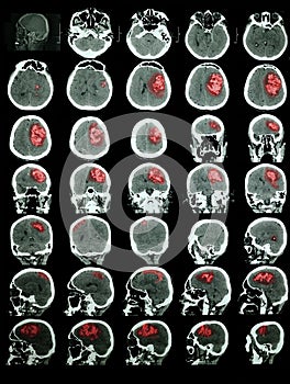 CT of the brain with hemorrhagic stroke photo
