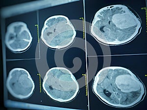 CT Brain impression a seven cm. extra-axial mass with stong enhancement and mass effect to left cerebral hemisphere.