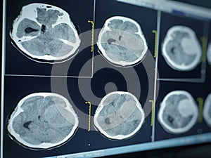 CT Brain impression a seven cm. extra-axial mass with stong enhancement and mass effect to left cerebral hemisphere.