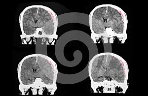 CT brain with large subdural hematoma photo