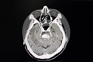Stroke CT brian photo