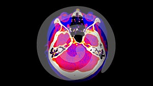 CT Brain Perfusion or CT scan image of the brain axial view