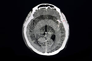 CT brain ruptured aneurysm