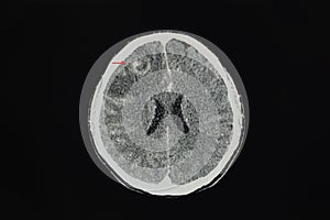 A CT brain scan of a patient with large brain tumor in the frontal lobe photo