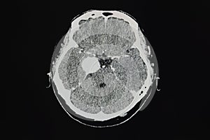 CT brain scan showing meningioma at right cavernous sinus photo