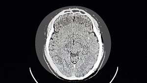 CT brain scan of a patient