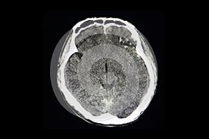 CT brain scan of a patient with bilateral hemorrhagic contusion