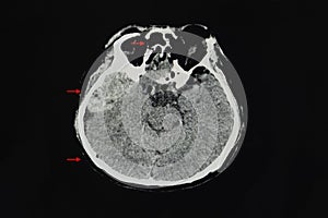 A CT brain scan of a patient with multiple fractures, epidural hematoma, and pneumocephalus photo