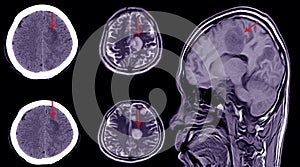 CT brain scan of a patient with history of mild head injury showing large subacute subdural hematoma photo