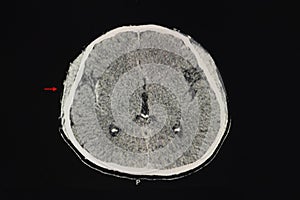 CT brain scan of a patient showing subural hemorrhage at right synlvian cistern