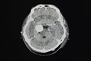 CT brain scan showing meningioma at right cavernous sinus