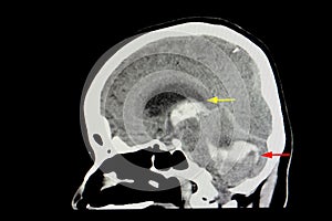 CT Brain Scan of Stroke Patient