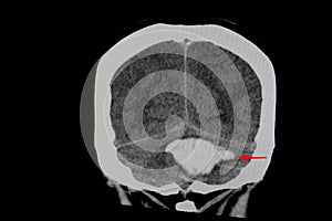 CT Brain Scan of Stroke Patient
