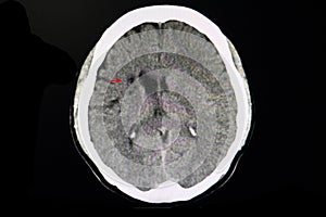 CT brain of a stroke patient