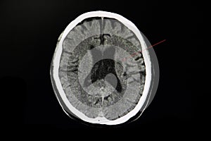 CT brain of a stroke patient