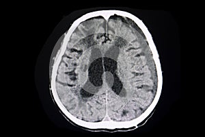 CT brain subacute subdural hematoma