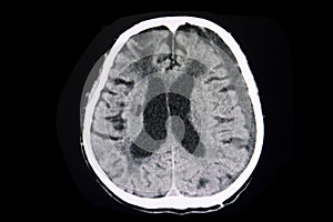 CT brain subacute subdural hematoma photo