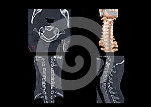 CT C-Spine or Cervical spine axial view , 3D Rendering image , Corona and sagittal  view i