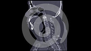 CT C-Spine or Cervical spine sagittal view